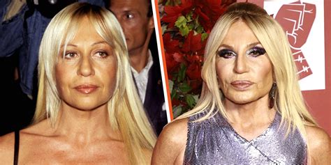 donatella versace before and after plastic surgery|Donatella Versace botox.